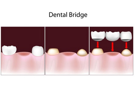 3 Unit Dental Bridge