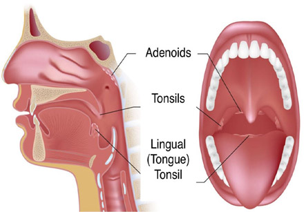 Adenoidectomy
