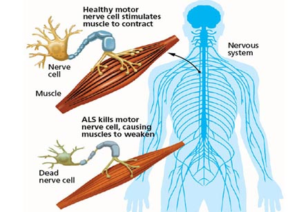 Amyotrophic Lateral Sclerosis ALS