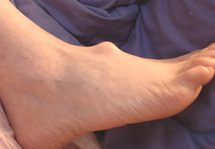 Bony Foot Deformity