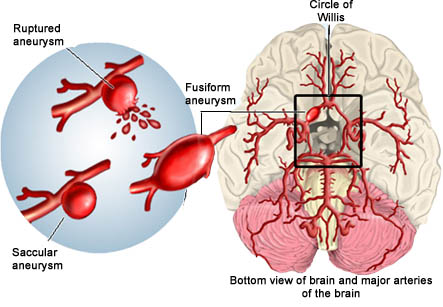 Brain Aneurysm
