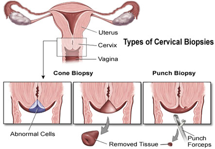 Cervical Biopsy