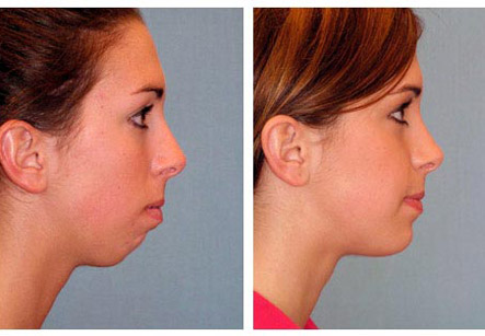 Chin Augmentation