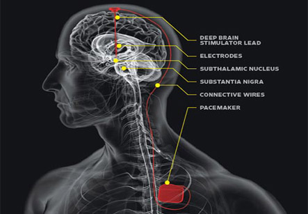 Deep Brain Stimulation for Parkinson’s