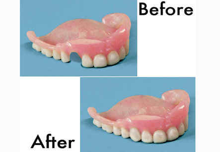 Dentures Repair