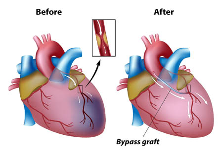 Heart Bypass
