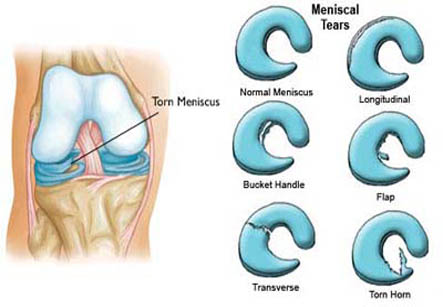 Knee Arthroscopy Both Menisci