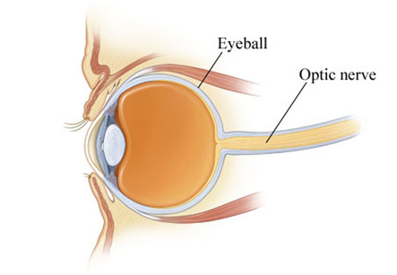 Optic Nerve Atrophy