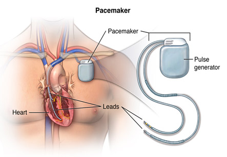 Pacemaker Insertion