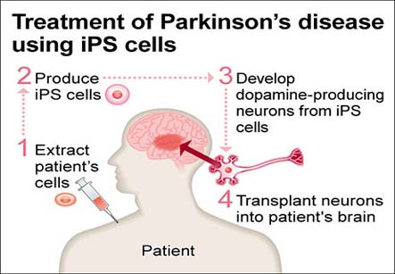 Parkinson’s