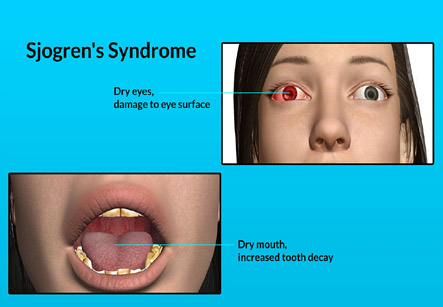 Sjogren’s syndrome