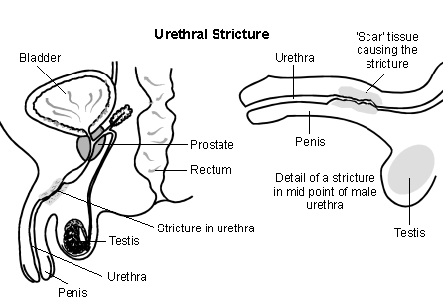 Urethra Stricture Surgery
