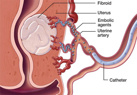 Uterine Fibroid Embolization UFE