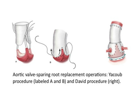 Valve Sparing Aortic Root Replacement