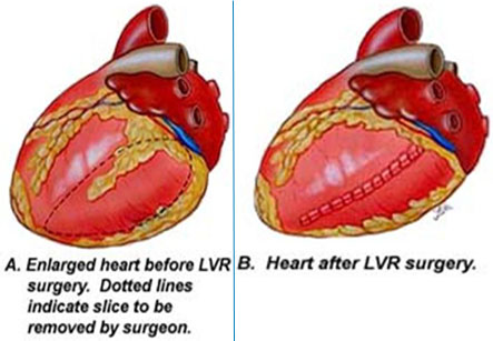 Ventricular Reduction